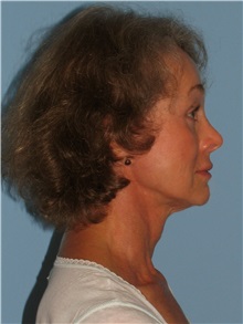 Facelift After Photo by Paul Vanek, MD, FACS; Concord, OH - Case 34028