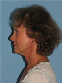 Facelift After Photo by Paul Vanek, MD, FACS; Concord, OH - Case 34028