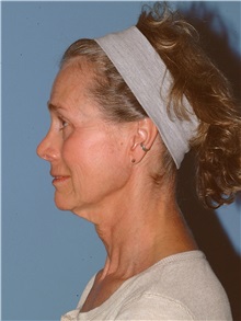 Facelift Before Photo by Paul Vanek, MD, FACS; Concord, OH - Case 34028