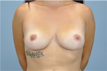 Breast Reduction After Photo by Paul Vanek, MD, FACS; Concord, OH - Case 34030