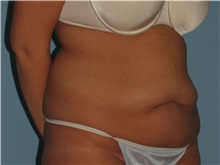 Tummy Tuck Before Photo by Paul Vanek, MD, FACS; Concord, OH - Case 34031