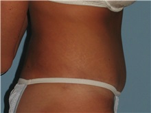 Tummy Tuck After Photo by Paul Vanek, MD, FACS; Concord, OH - Case 34031