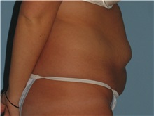 Tummy Tuck Before Photo by Paul Vanek, MD, FACS; Concord, OH - Case 34031