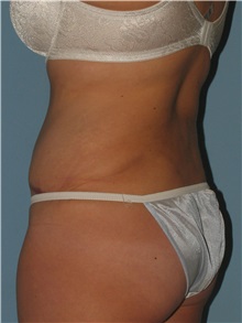 Liposuction After Photo by Paul Vanek, MD, FACS; Concord, OH - Case 34032