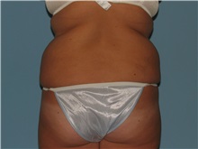 Liposuction Before Photo by Paul Vanek, MD, FACS; Concord, OH - Case 34032