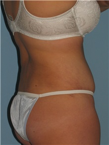 Liposuction After Photo by Paul Vanek, MD, FACS; Concord, OH - Case 34032