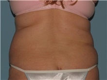Liposuction After Photo by Paul Vanek, MD, FACS; Concord, OH - Case 34034