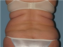 Liposuction Before Photo by Paul Vanek, MD, FACS; Concord, OH - Case 34034