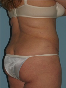 Liposuction After Photo by Paul Vanek, MD, FACS; Concord, OH - Case 34034