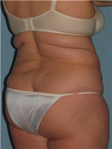 Liposuction Before Photo by Paul Vanek, MD, FACS; Concord, OH - Case 34034