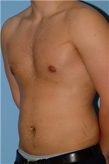 Male Breast Reduction After Photo by Paul Vanek, MD, FACS; Concord, OH - Case 34036