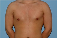 Male Breast Reduction After Photo by Paul Vanek, MD, FACS; Concord, OH - Case 34036