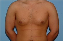 Male Breast Reduction Before Photo by Paul Vanek, MD, FACS; Concord, OH - Case 34036