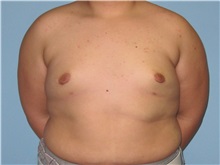 Male Breast Reduction After Photo by Paul Vanek, MD, FACS; Concord, OH - Case 34232