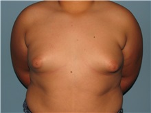 Male Breast Reduction Before Photo by Paul Vanek, MD, FACS; Concord, OH - Case 34232