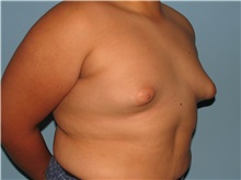 Male Breast Reduction Before Photo by Paul Vanek, MD, FACS; Concord, OH - Case 34232
