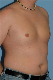 Male Breast Reduction After Photo by Paul Vanek, MD, FACS; Concord, OH - Case 34233