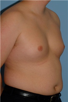 Male Breast Reduction Before Photo by Paul Vanek, MD, FACS; Concord, OH - Case 34233