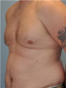 Male Breast Reduction After Photo by Paul Vanek, MD, FACS; Concord, OH - Case 34296