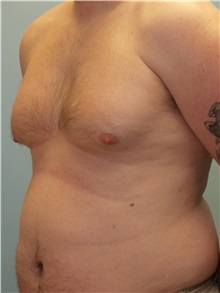 Male Breast Reduction Before Photo by Paul Vanek, MD, FACS; Concord, OH - Case 34296