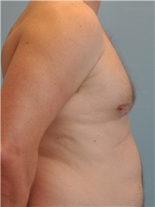 Male Breast Reduction After Photo by Paul Vanek, MD, FACS; Concord, OH - Case 34296