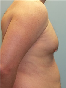 Male Breast Reduction Before Photo by Paul Vanek, MD, FACS; Concord, OH - Case 34296