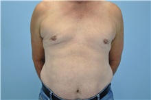 Male Breast Reduction After Photo by Paul Vanek, MD, FACS; Concord, OH - Case 34297