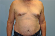 Male Breast Reduction Before Photo by Paul Vanek, MD, FACS; Concord, OH - Case 34297