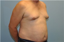 Male Breast Reduction Before Photo by Paul Vanek, MD, FACS; Concord, OH - Case 34297