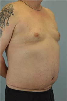 Body Contouring After Photo by Paul Vanek, MD, FACS; Concord, OH - Case 34298