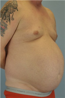 Body Contouring Before Photo by Paul Vanek, MD, FACS; Concord, OH - Case 34298