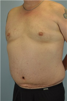 Body Contouring After Photo by Paul Vanek, MD, FACS; Concord, OH - Case 34298