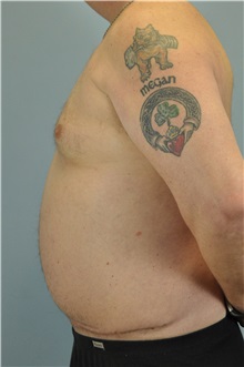 Body Contouring After Photo by Paul Vanek, MD, FACS; Concord, OH - Case 34298