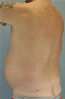 Body Contouring Before Photo by Paul Vanek, MD, FACS; Concord, OH - Case 34298