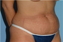 Tummy Tuck Before Photo by Paul Vanek, MD, FACS; Concord, OH - Case 35117