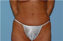 Tummy Tuck After Photo by Paul Vanek, MD, FACS; Concord, OH - Case 35117