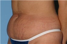 Tummy Tuck Before Photo by Paul Vanek, MD, FACS; Concord, OH - Case 35117