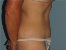 Tummy Tuck After Photo by Paul Vanek, MD, FACS; Concord, OH - Case 35127