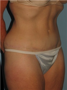 Tummy Tuck After Photo by Paul Vanek, MD, FACS; Concord, OH - Case 35127