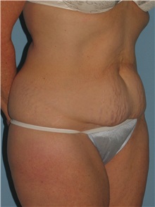 Tummy Tuck Before Photo by Paul Vanek, MD, FACS; Concord, OH - Case 35127
