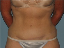 Tummy Tuck After Photo by Paul Vanek, MD, FACS; Concord, OH - Case 35127