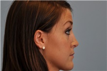 Rhinoplasty After Photo by Paul Vanek, MD, FACS; Concord, OH - Case 35388