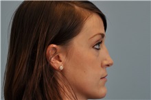 Rhinoplasty Before Photo by Paul Vanek, MD, FACS; Concord, OH - Case 35388