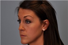Rhinoplasty After Photo by Paul Vanek, MD, FACS; Concord, OH - Case 35388