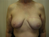 Breast Reconstruction After Photo by Frank Ferraro, MD; Paramus, NJ - Case 23494