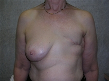 Breast Reconstruction Before Photo by Frank Ferraro, MD; Paramus, NJ - Case 23494