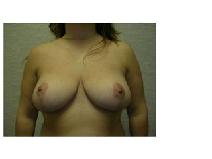 Breast Reduction After Photo by Frank Ferraro, MD; Paramus, NJ - Case 9529