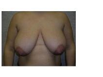 Breast Reduction Before Photo by Frank Ferraro, MD; Paramus, NJ - Case 9529