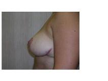 Breast Reduction After Photo by Frank Ferraro, MD; Paramus, NJ - Case 9529