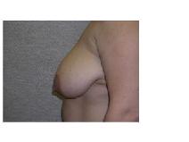 Breast Reduction Before Photo by Frank Ferraro, MD; Paramus, NJ - Case 9529